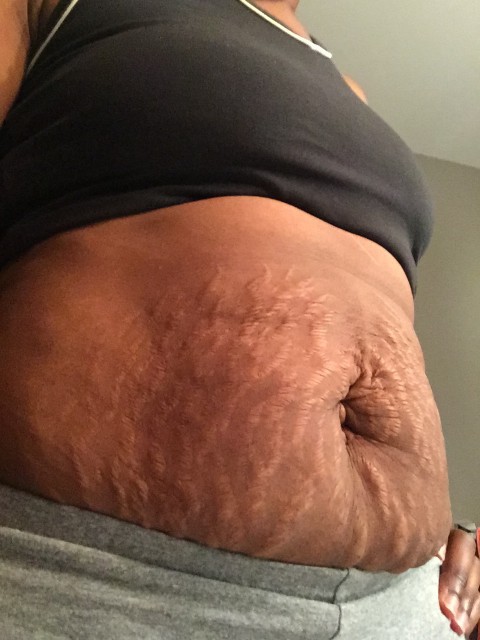 Natalie This is 40 Stretch Marks